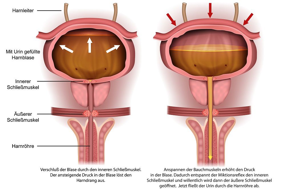 Was ist Inkontinenz? - Ursachen, Formen und Symptome von Blasenschwäche und Stuhlinkontinenz